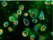 Israeli Scientists Discover New Enzyme to Destroy in Metatastic Cancer Cells